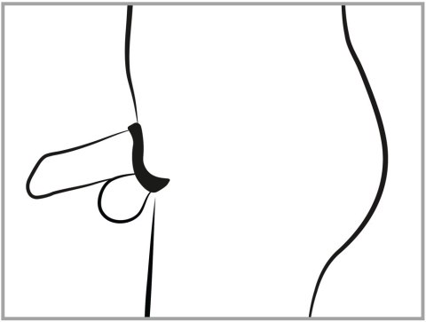 Cock Cage with Dilator